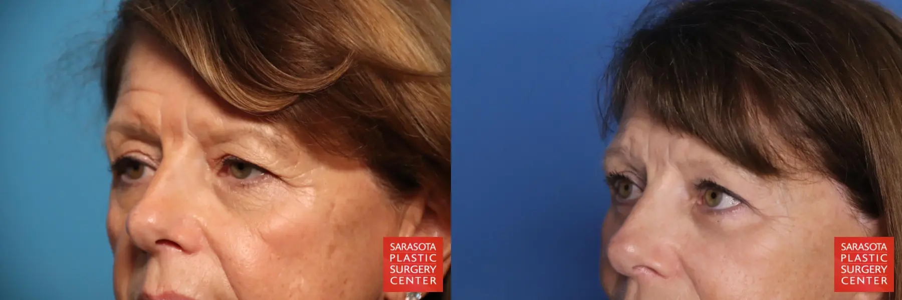 Eyelid Lift: Patient 62 - Before and After 3