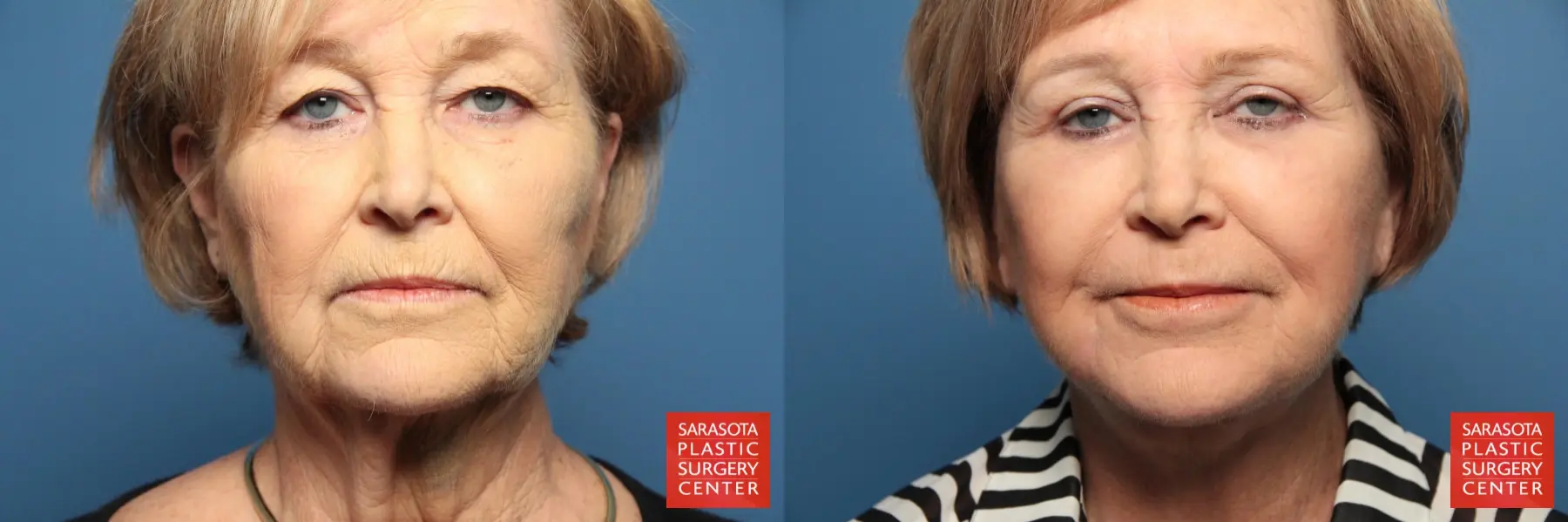 Eyelid Lift: Patient 22 - Before and After 1
