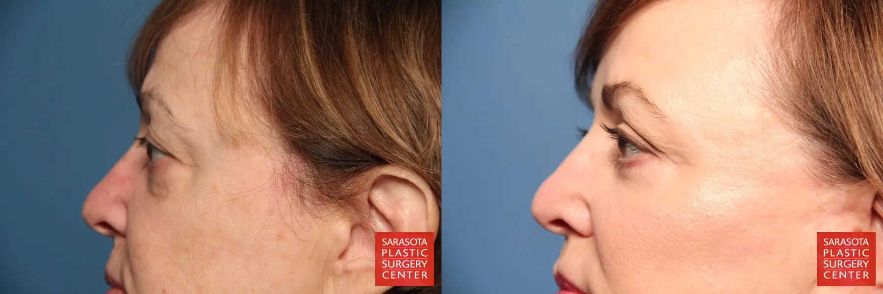Eyelid Lift: Patient 70 - Before and After 3