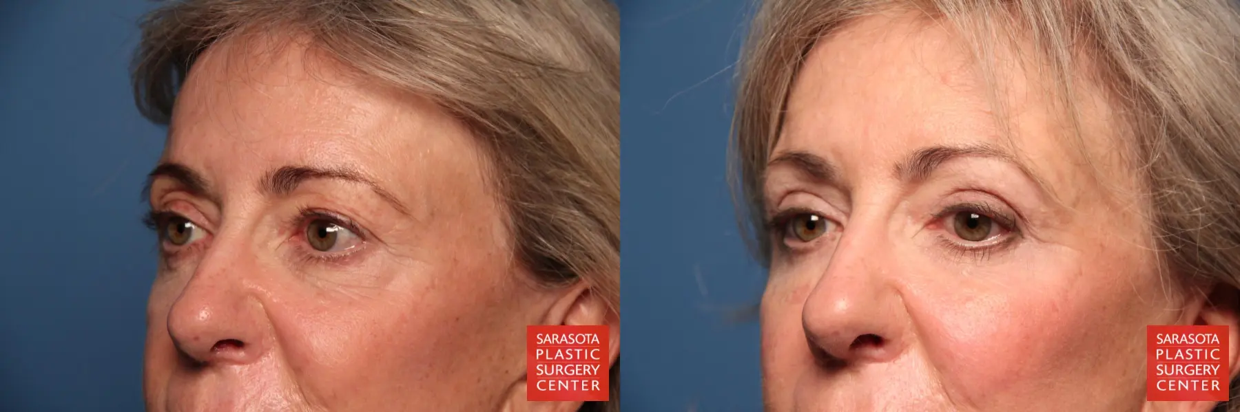 Eyelid Lift: Patient 24 - Before and After 2