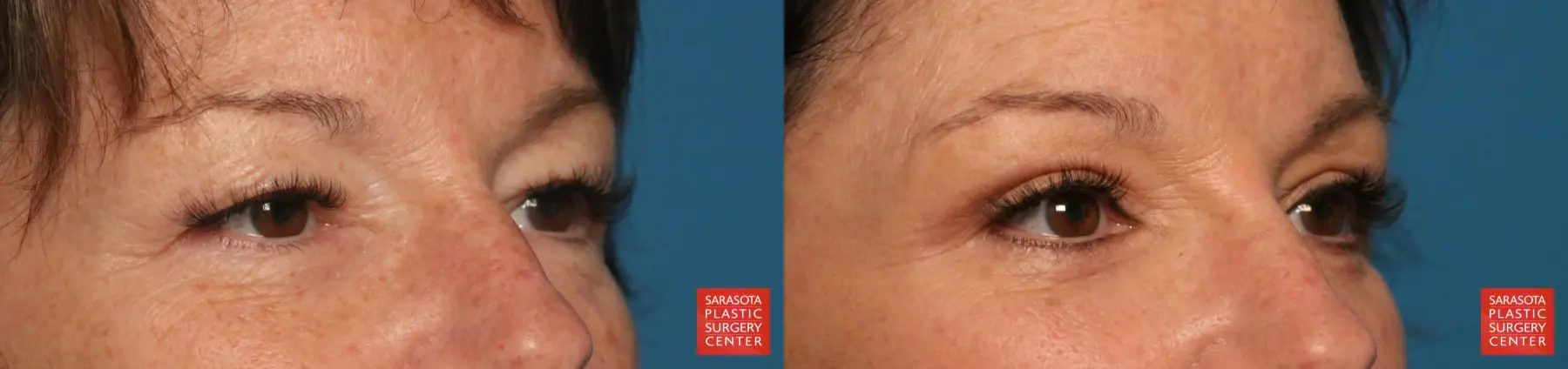 Eyelid Lift: Patient 67 - Before and After 5