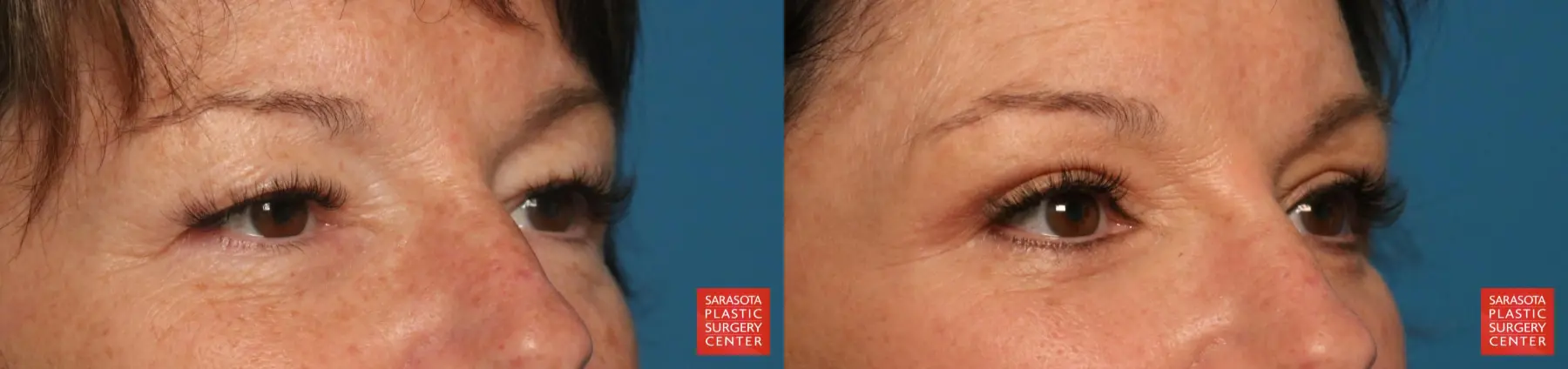 Eyelid Lift: Patient 69 - Before and After 5