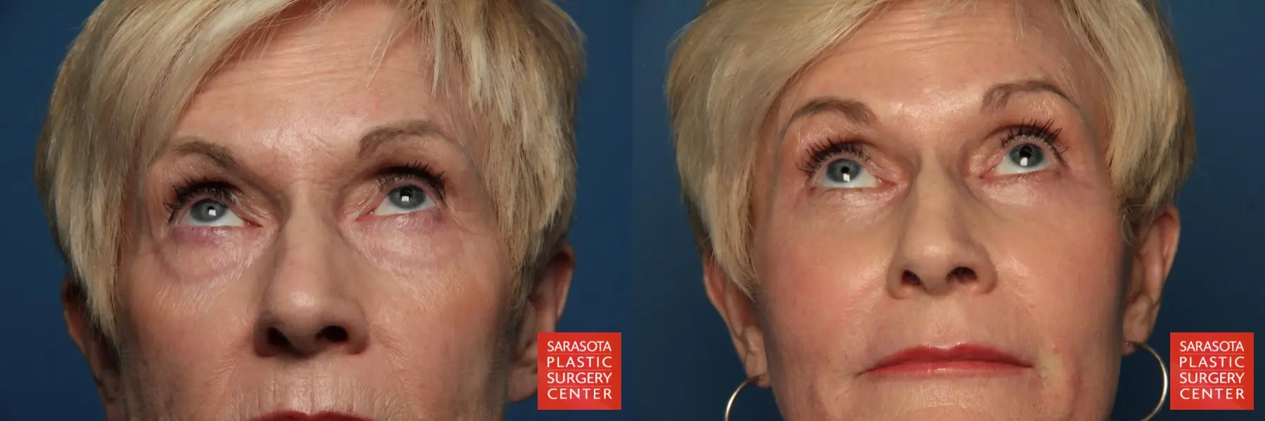 Eyelid Lift: Patient 30 - Before and After 6