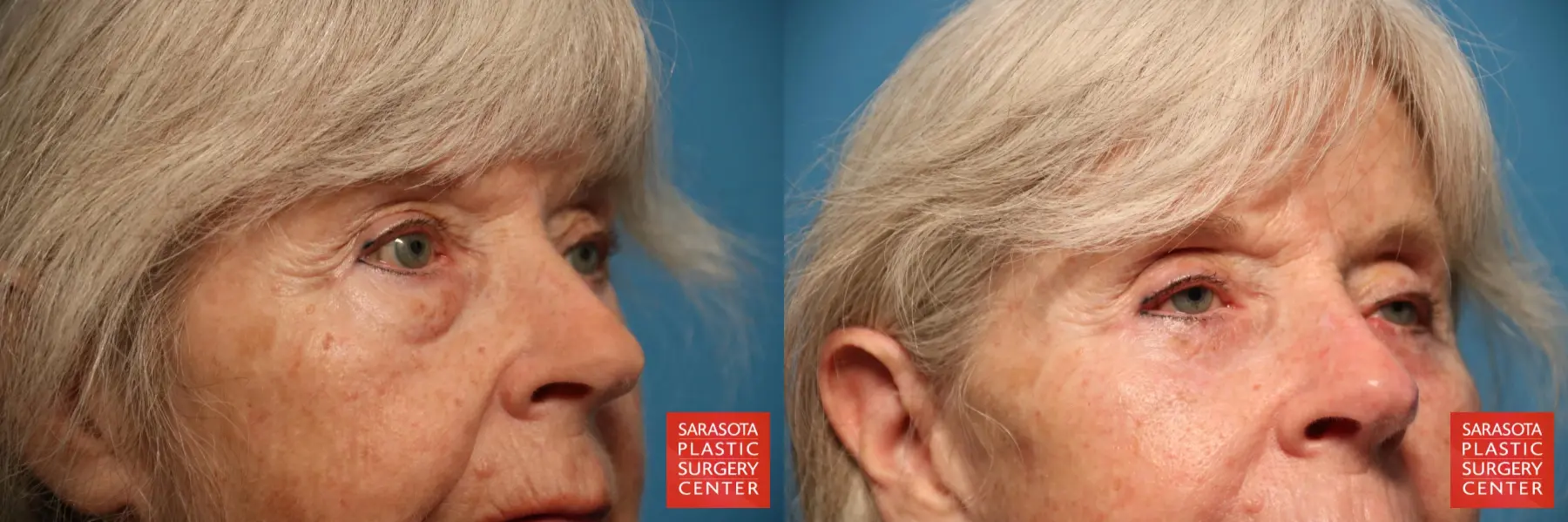Eyelid Lift: Patient 15 - Before and After 3