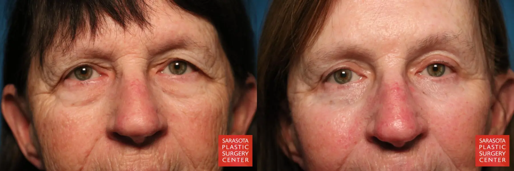 Eyelid Lift: Patient 51 - Before and After 1