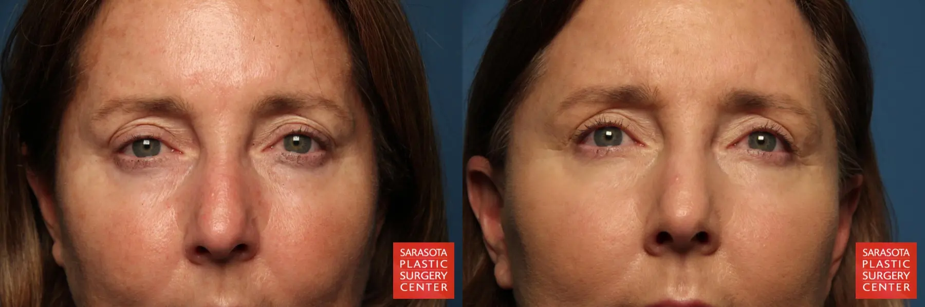 Eyelid Lift: Patient 36 - Before and After 1