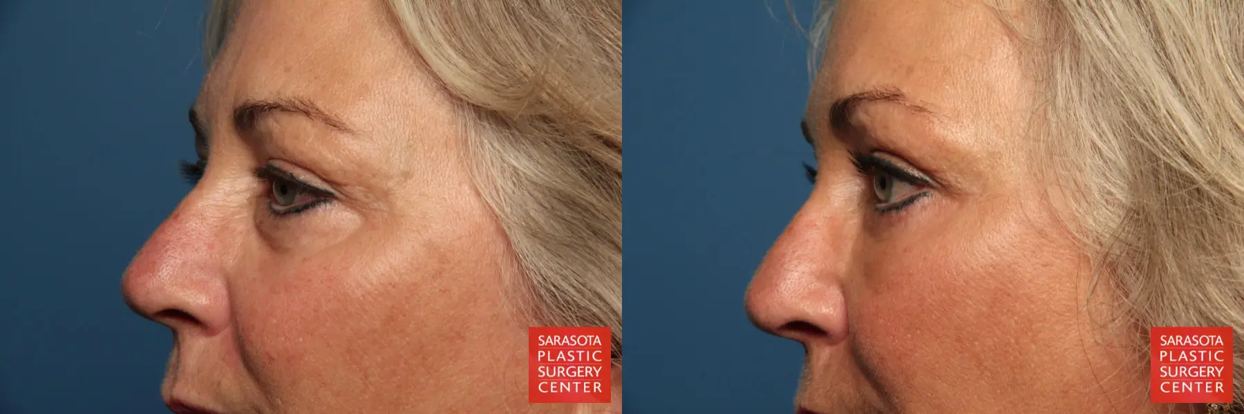Eyelid Lift: Patient 38 - Before and After 3