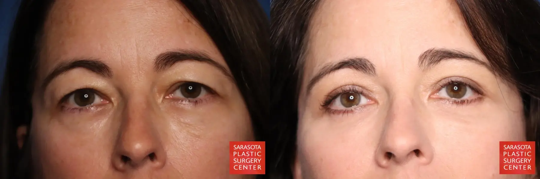 Eyelid Lift: Patient 3 - Before and After  