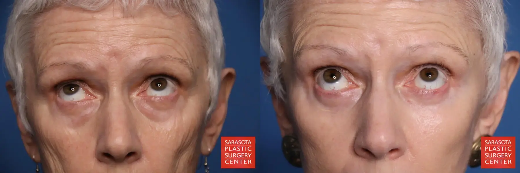 Eyelid Lift: Patient 55 - Before and After 2