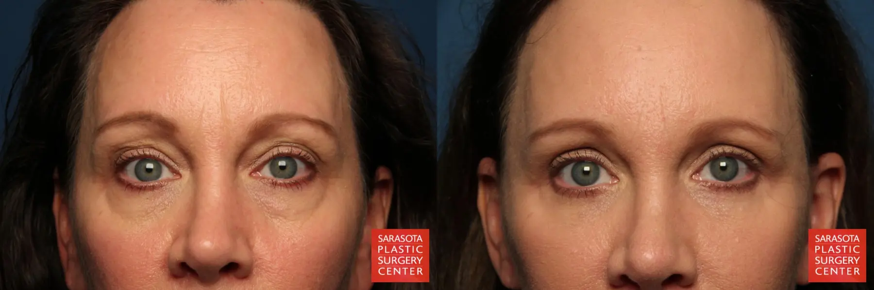 Eyelid Lift: Patient 41 - Before and After 1