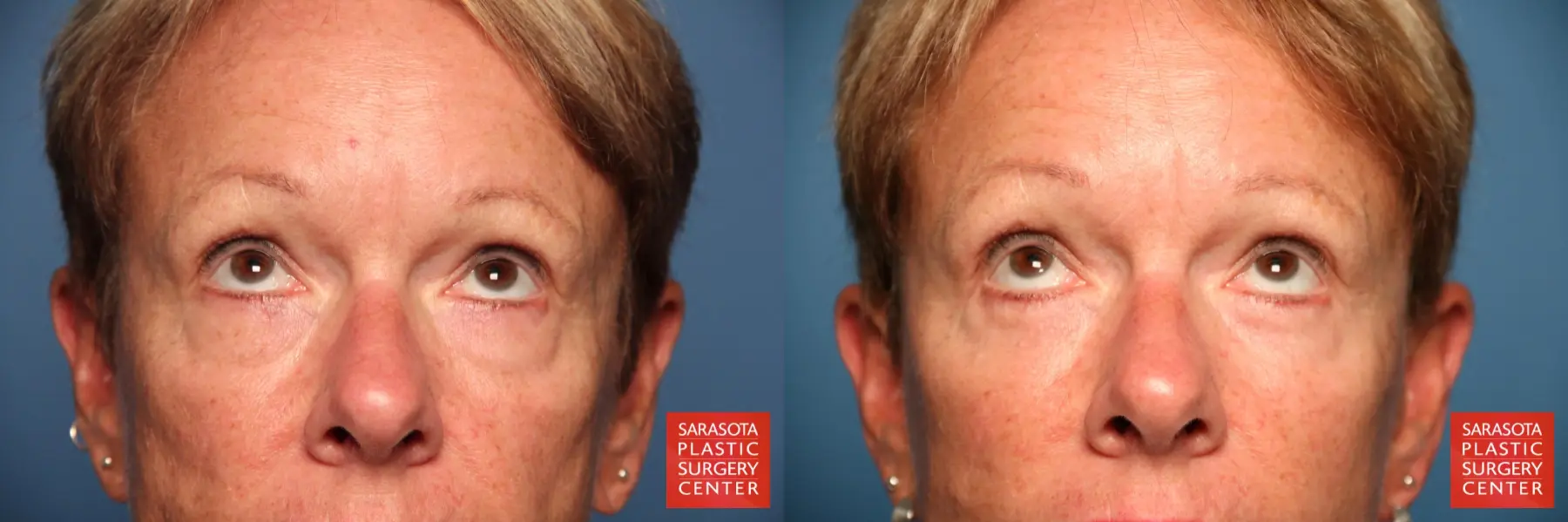 Eyelid Lift: Patient 18 - Before and After 4