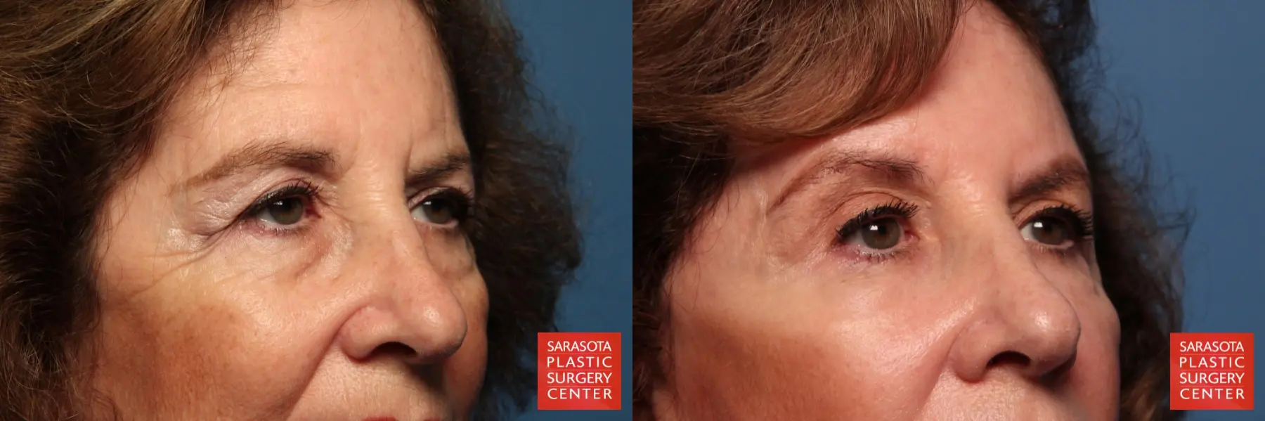 Eyelid Lift: Patient 42 - Before and After 6