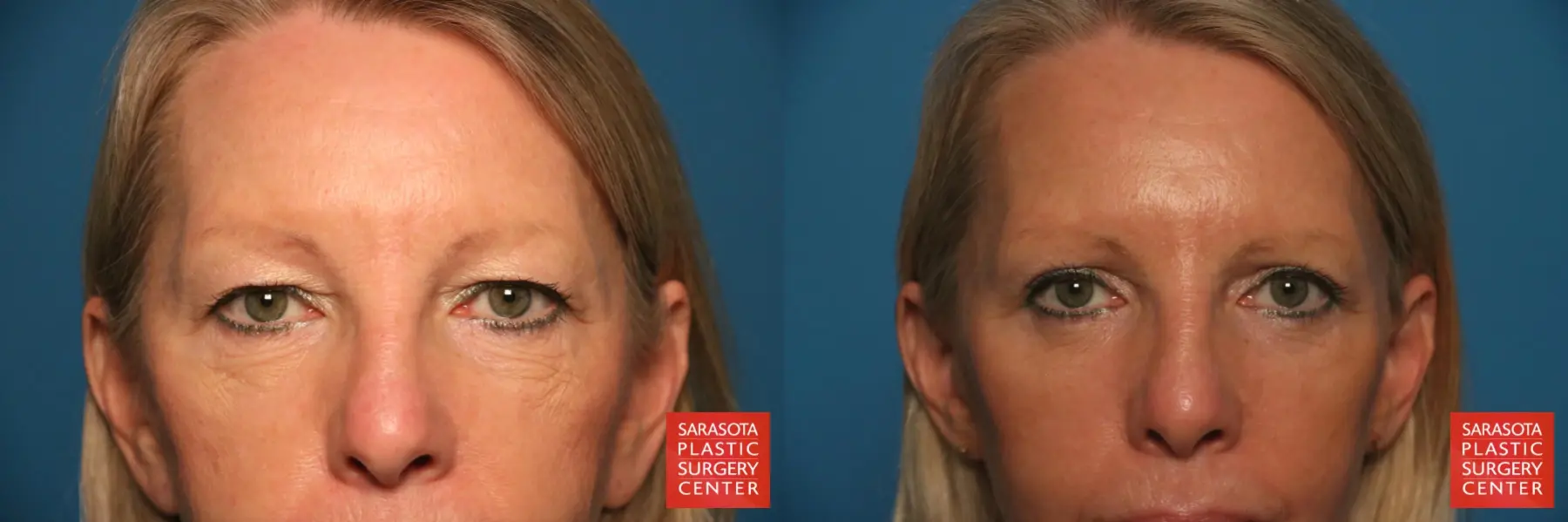 Eyelid Lift: Patient 54 - Before and After 1