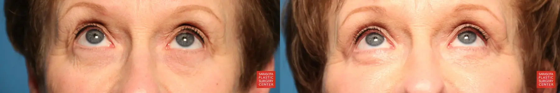 Eyelid Lift: Patient 21 - Before and After 2