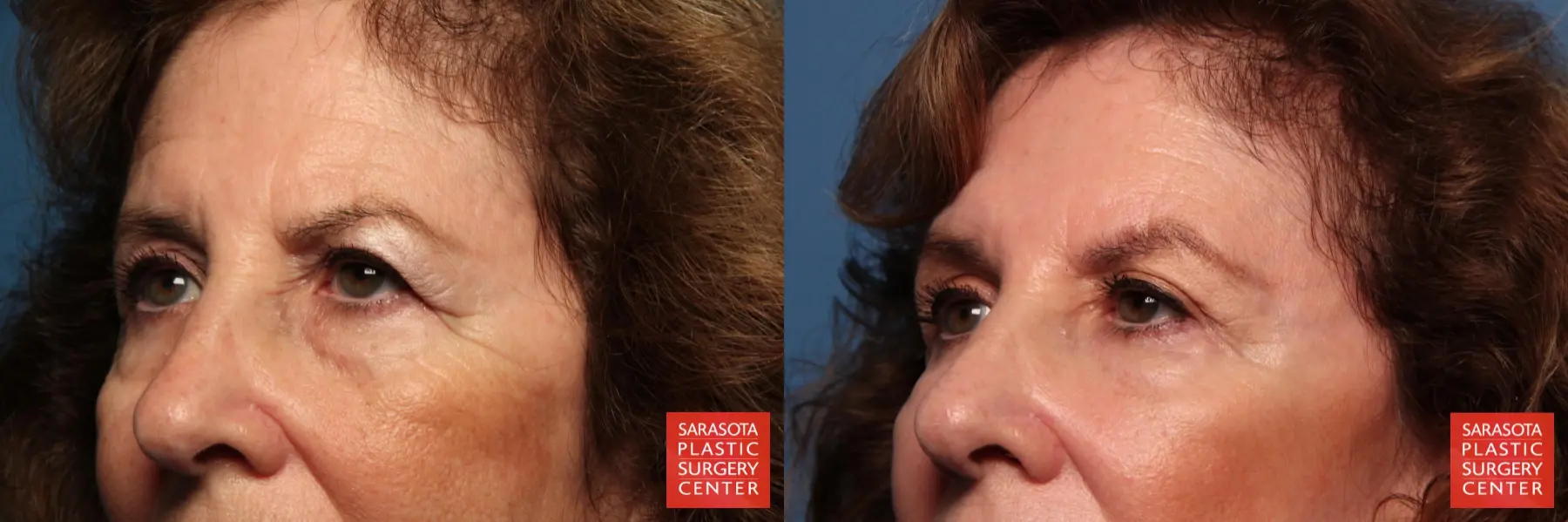 Eyelid Lift: Patient 42 - Before and After 4