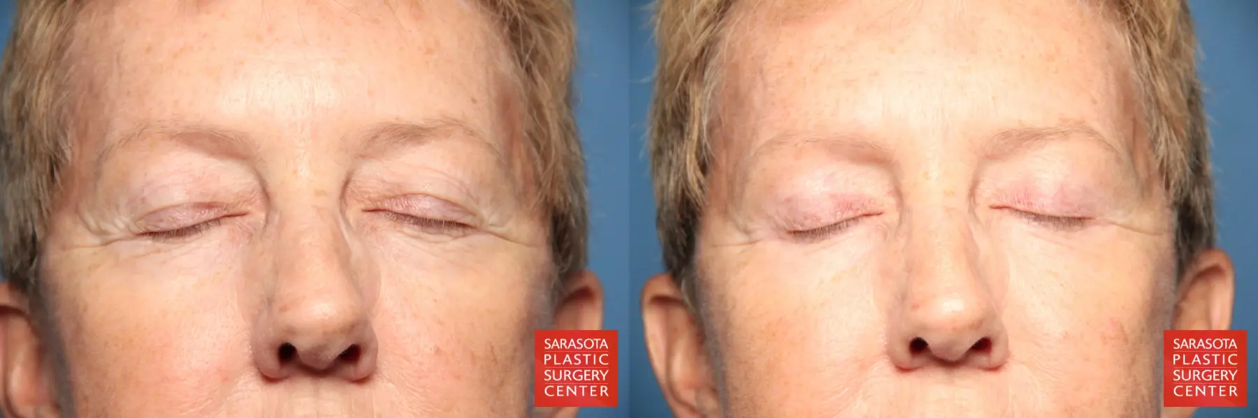 Eyelid Lift: Patient 22 - Before and After 2