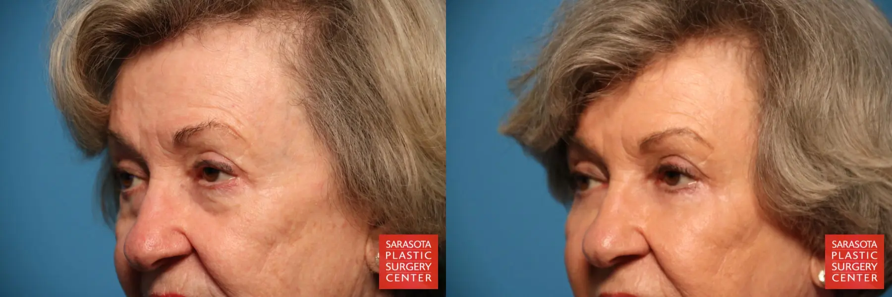 Eyelid Lift: Patient 14 - Before and After 4