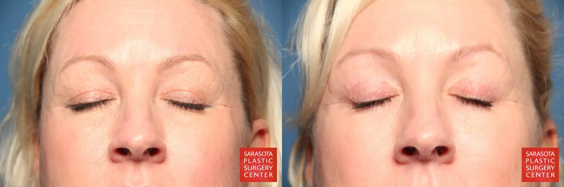 Eyelid Lift: Patient 4 - Before and After 5