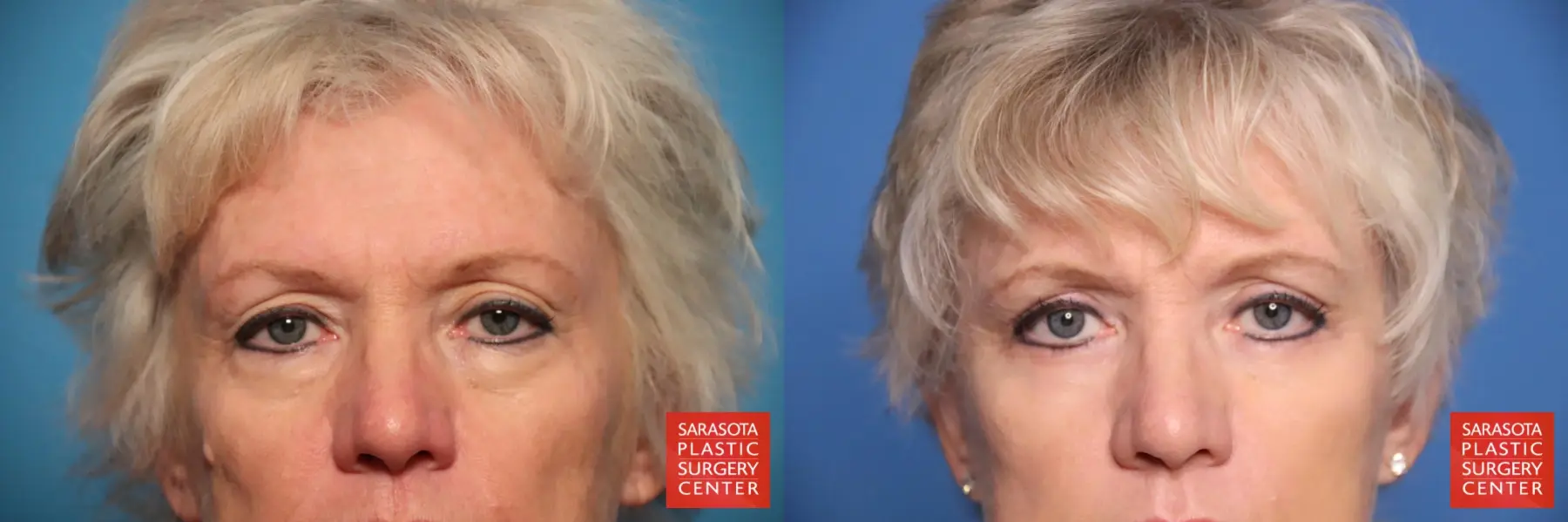 Eyelid Lift: Patient 49 - Before and After 1