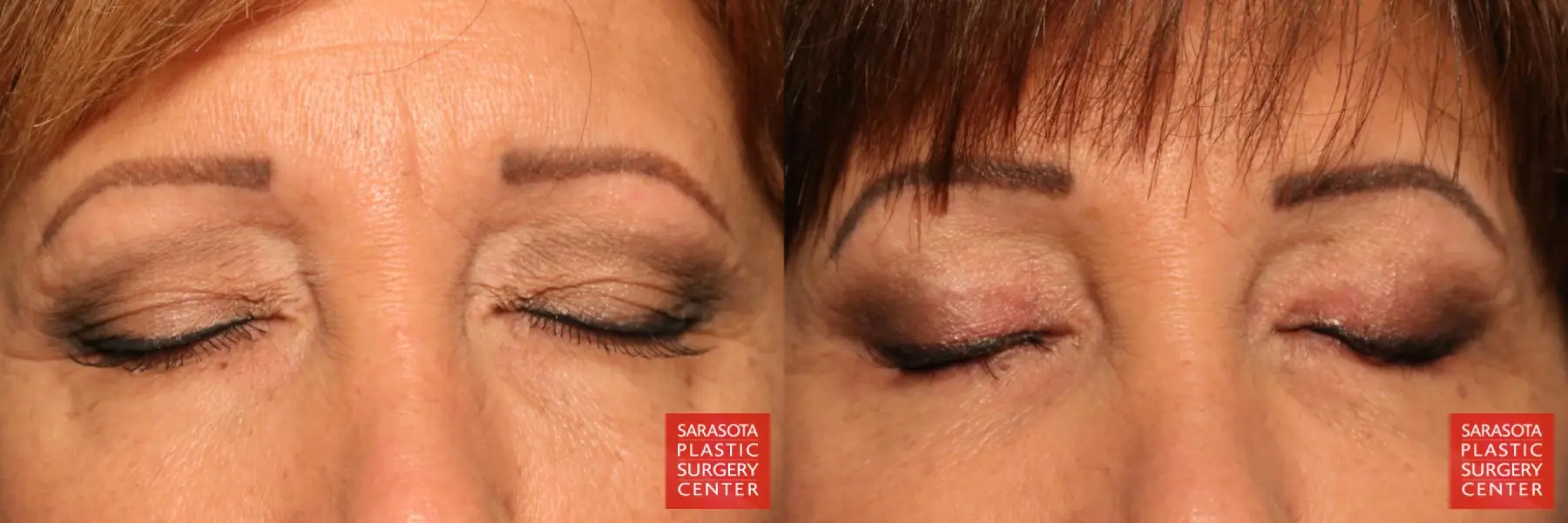 Eyelid Lift: Patient 9 - Before and After 2