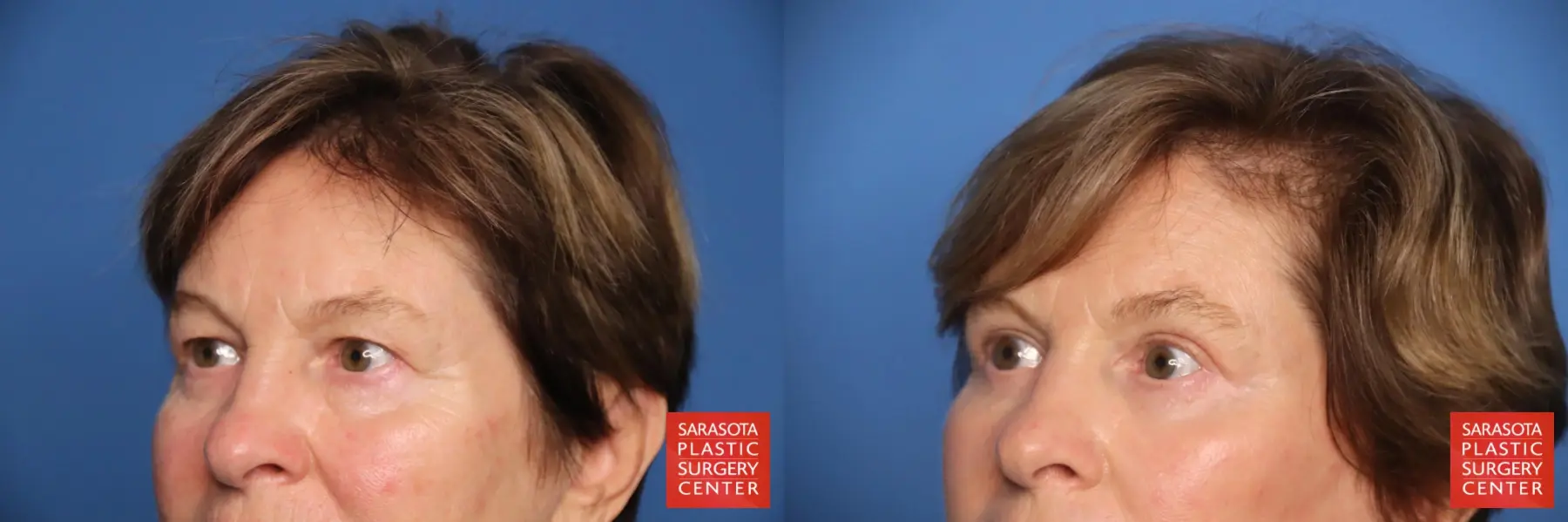 Eyelid Lift: Patient 67 - Before and After 3