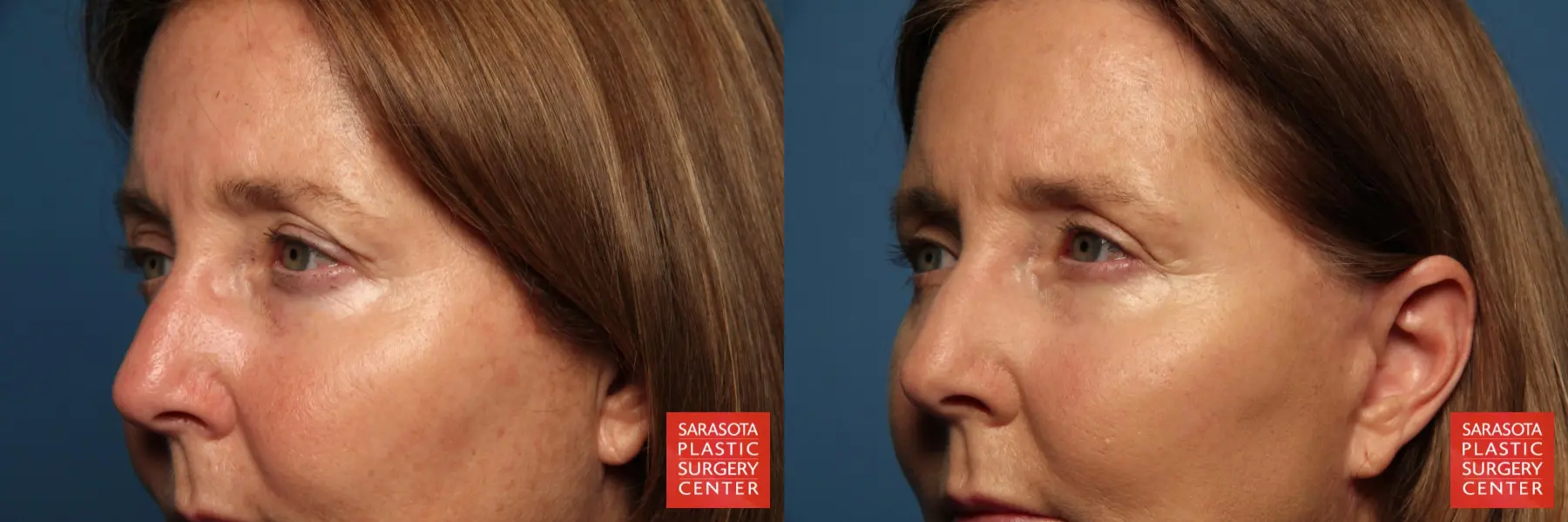 Eyelid Lift: Patient 36 - Before and After 2