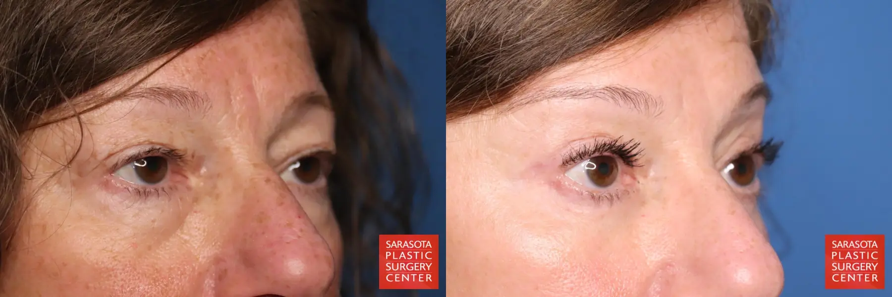 Eyelid Lift: Patient 58 - Before and After 6