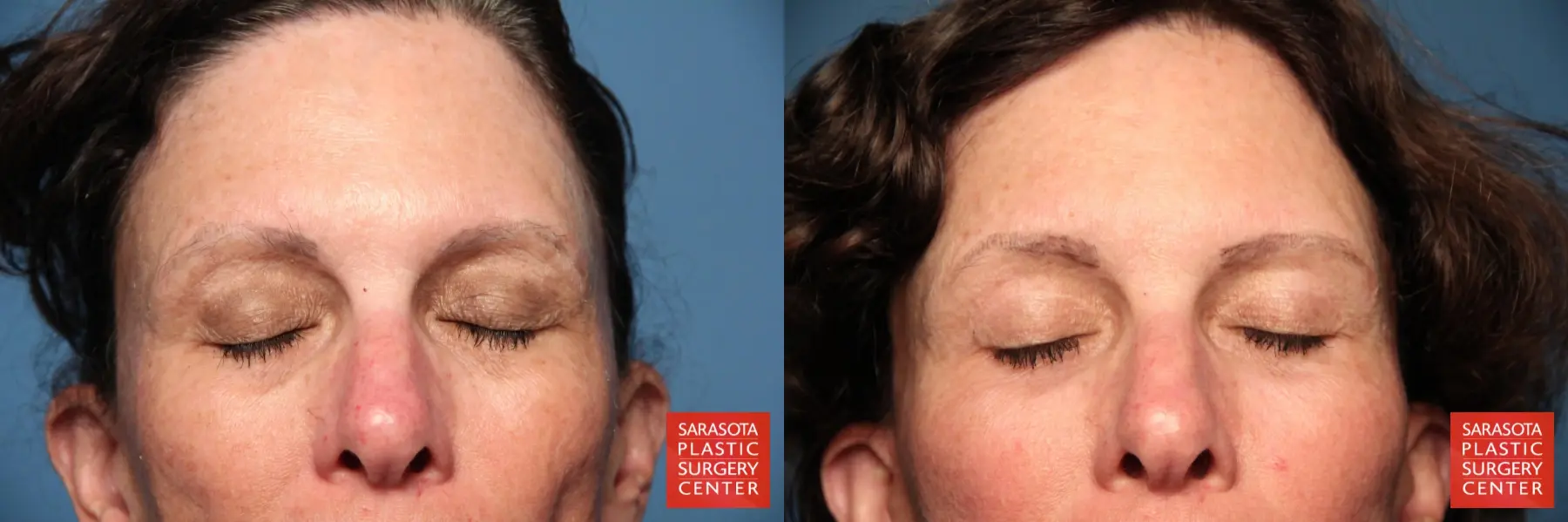 Eyelid Lift: Patient 8 - Before and After 2