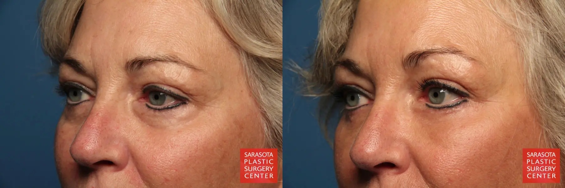 Eyelid Lift: Patient 39 - Before and After 2