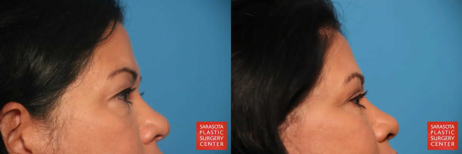 Eyelid Lift: Patient 47 - Before and After 5
