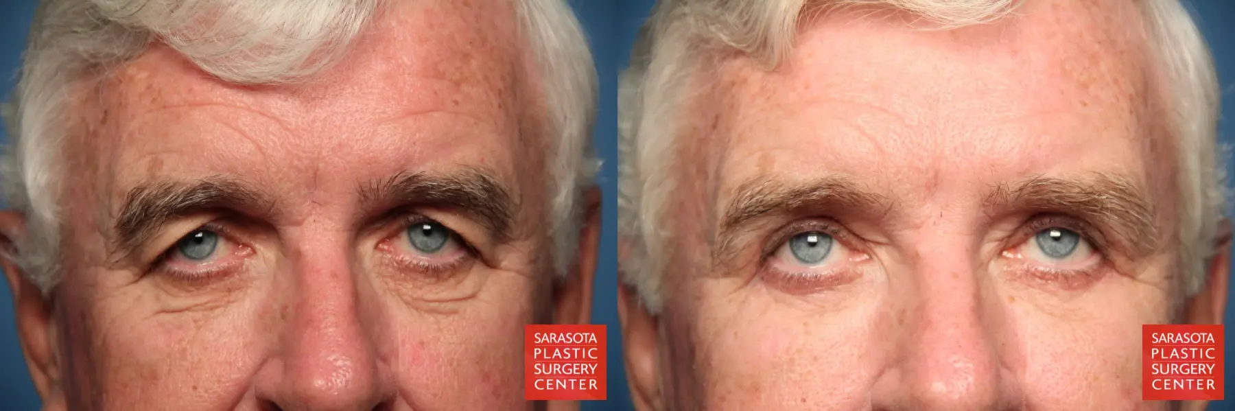Eyelid Lift For Men: Patient 1 - Before and After 4