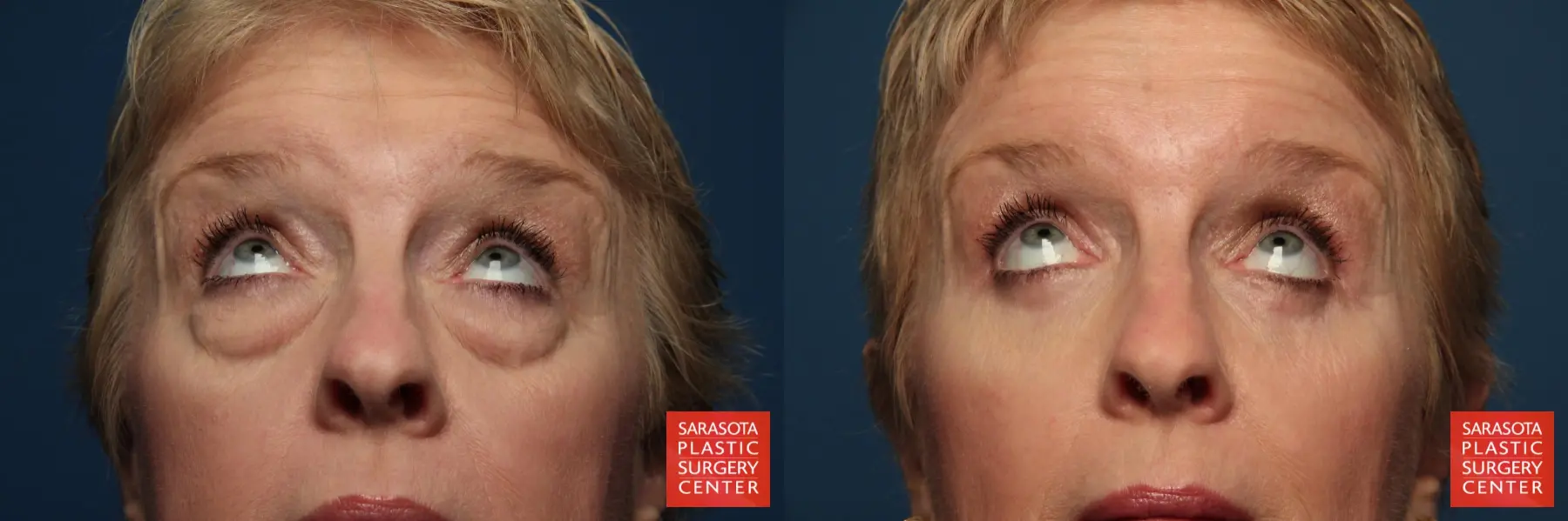 Eyelid Lift: Patient 1 - Before and After 4