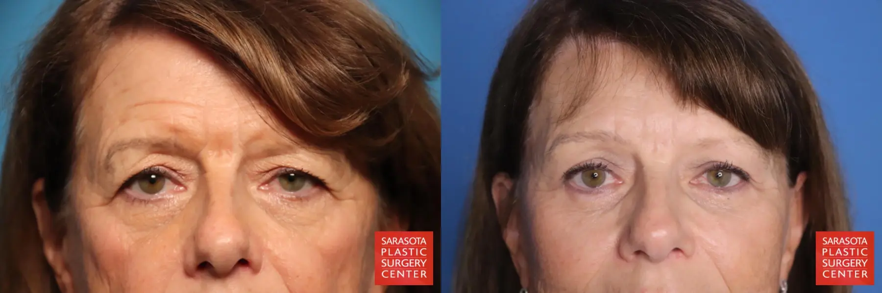 Eyelid Lift: Patient 62 - Before and After 1
