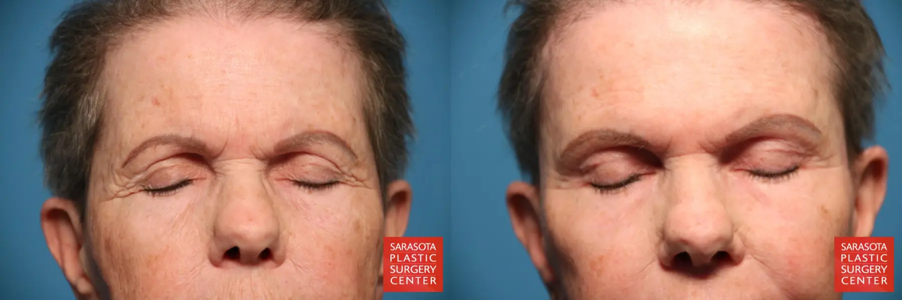 Eyelid Lift: Patient 29 - Before and After 2