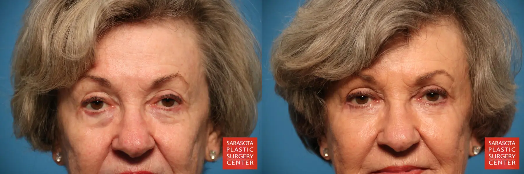 Eyelid Lift: Patient 14 - Before and After 1