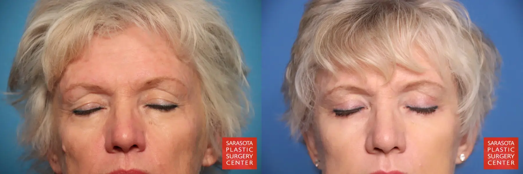 Eyelid Lift: Patient 50 - Before and After 3