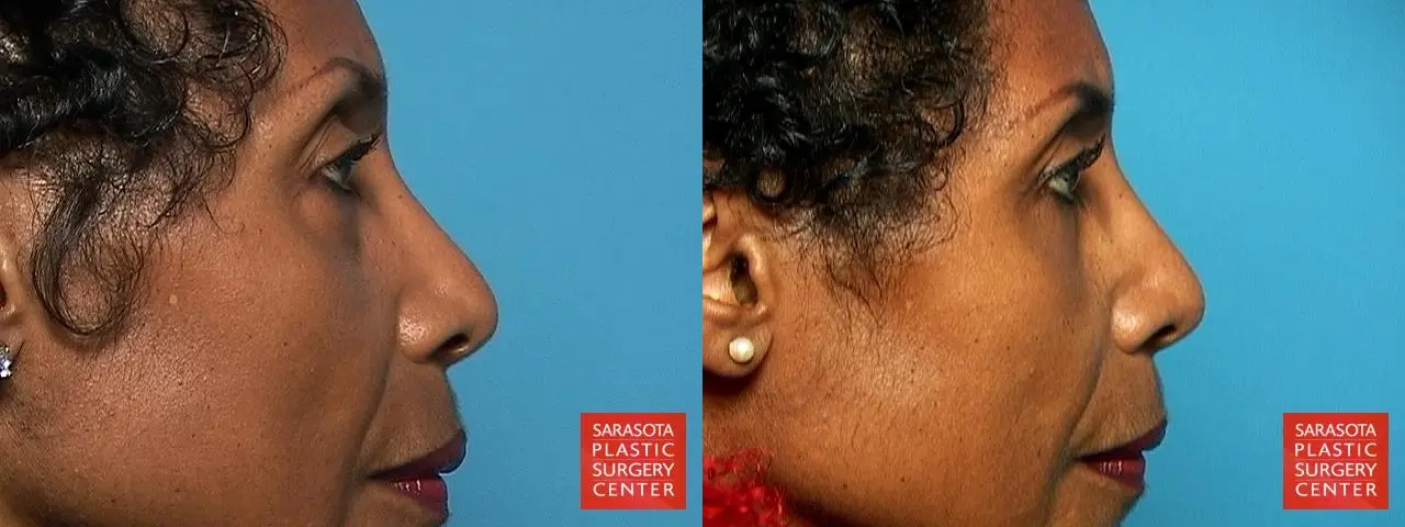 Eyelid Lift: Patient 10 - Before and After 3