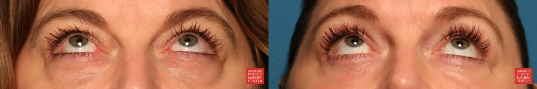 Eyelid Lift: Patient 6 - Before and After 3