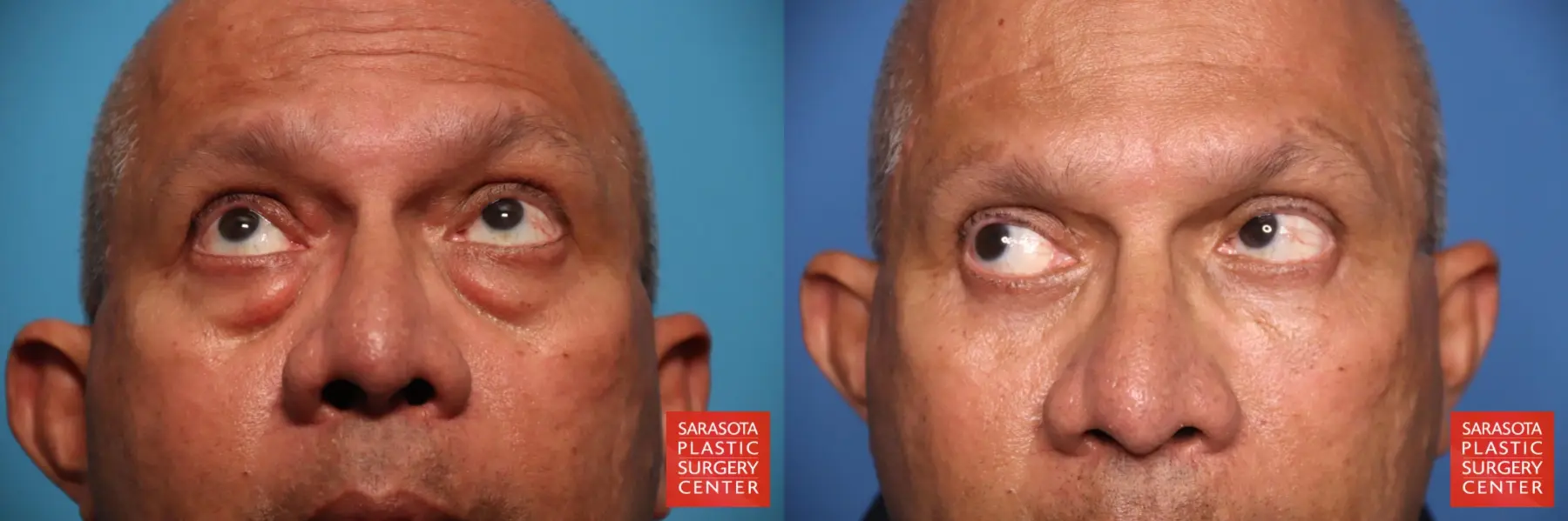 Eyelid Lift: Patient 56 - Before and After 2