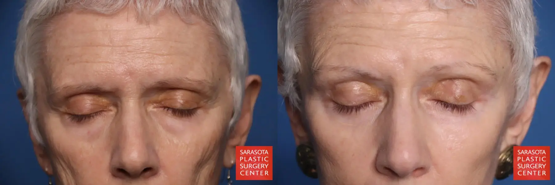 Eyelid Lift: Patient 55 - Before and After 3