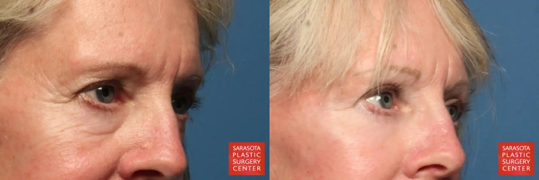 Eyelid Lift: Patient 32 - Before and After 2