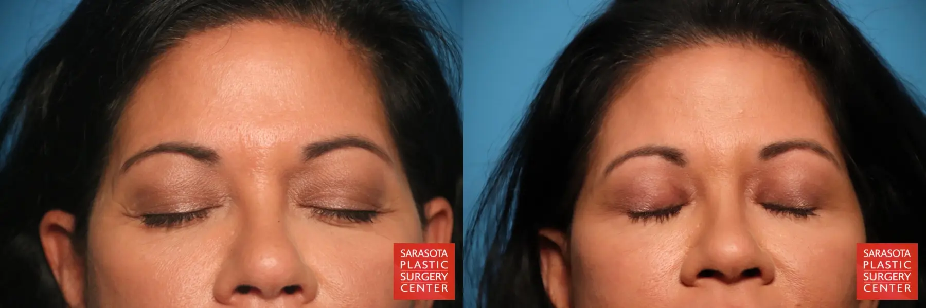 Eyelid Lift: Patient 47 - Before and After 3