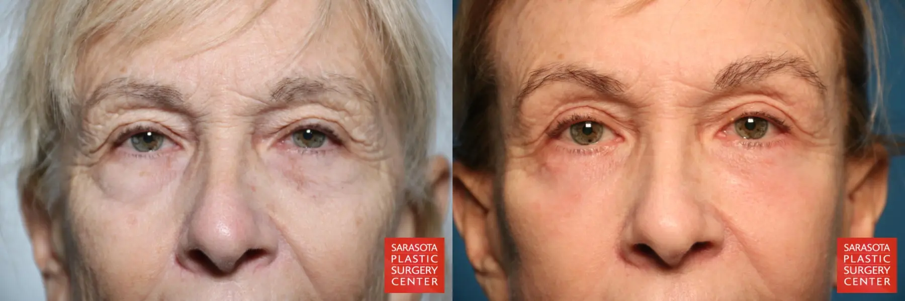 Eyelid Lift: Patient 43 - Before and After 1
