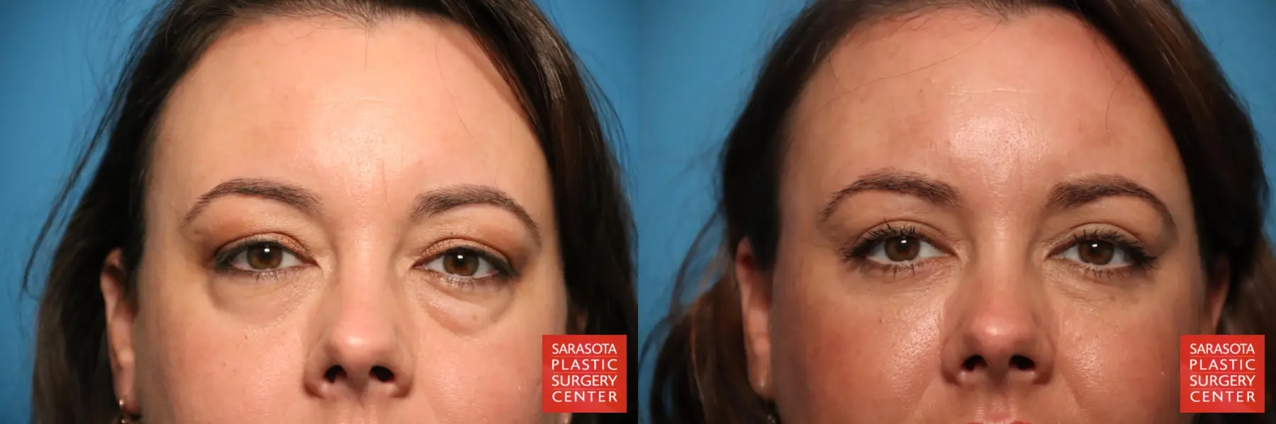 Eyelid Lift: Patient 60 - Before and After 1