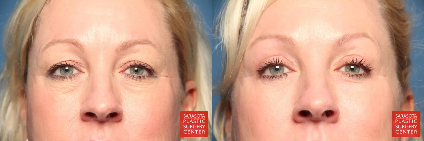 Eyelid Lift: Patient 4 - Before and After  