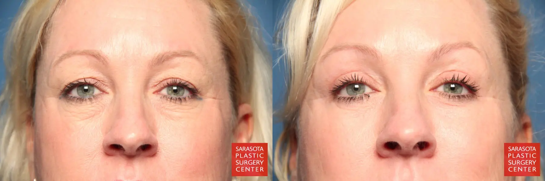 Eyelid Lift: Patient 5 - Before and After  