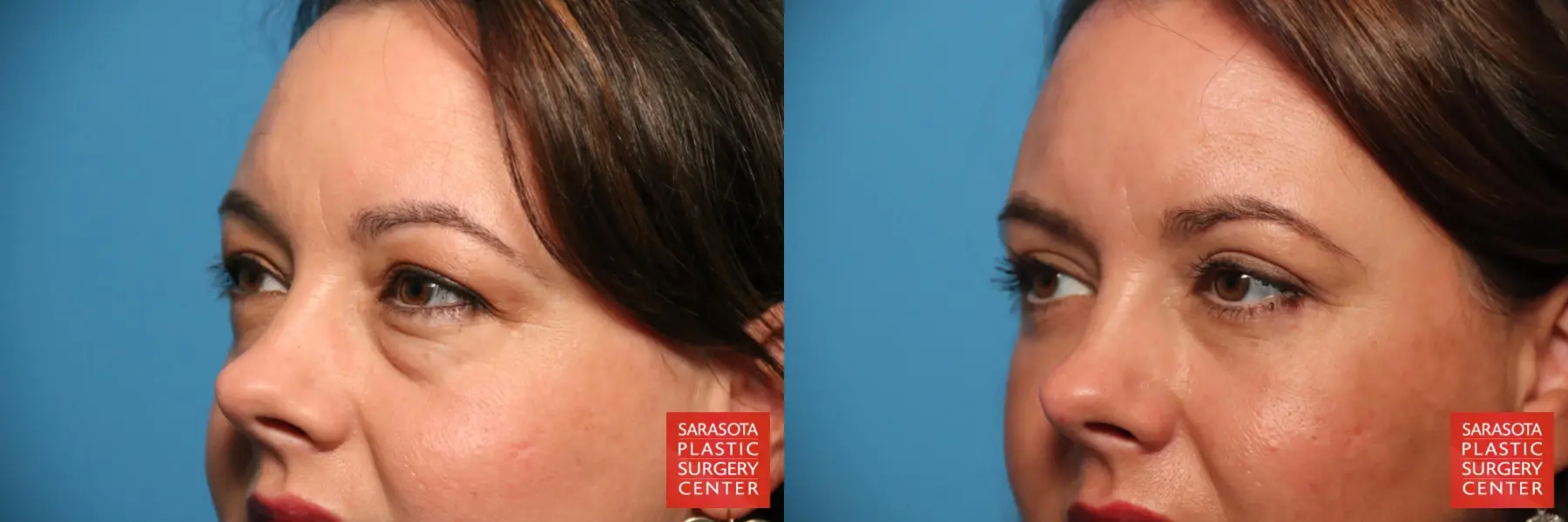 Eyelid Lift: Patient 60 - Before and After 2