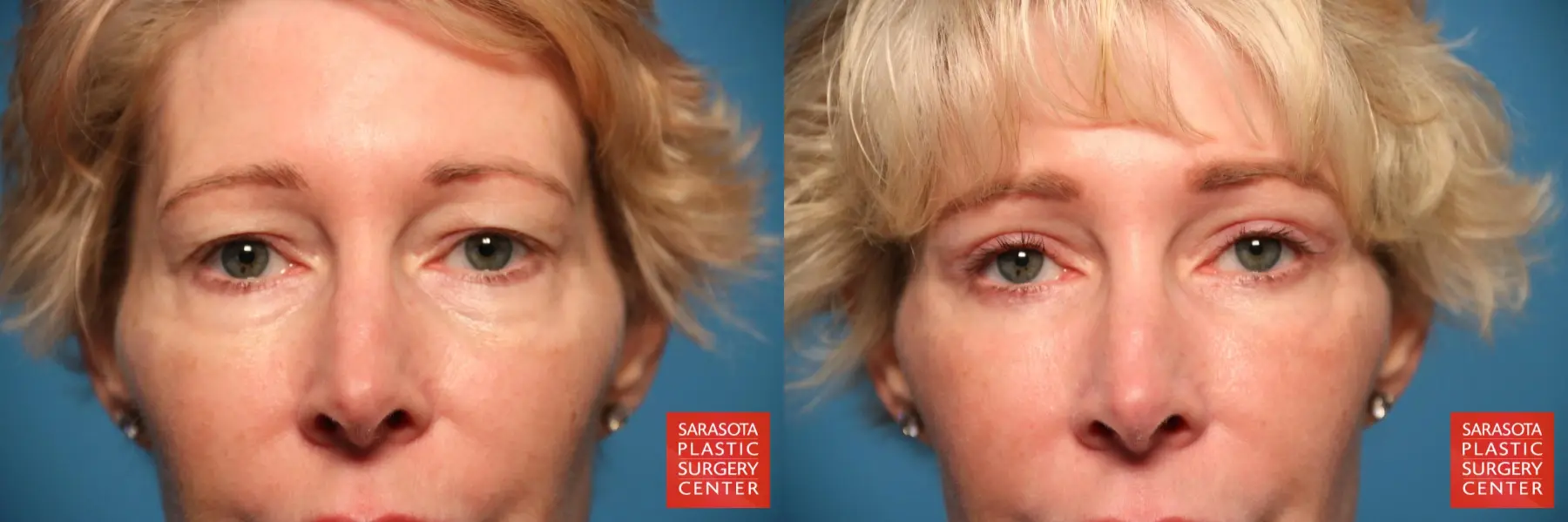 Eyelid Lift: Patient 13 - Before and After  