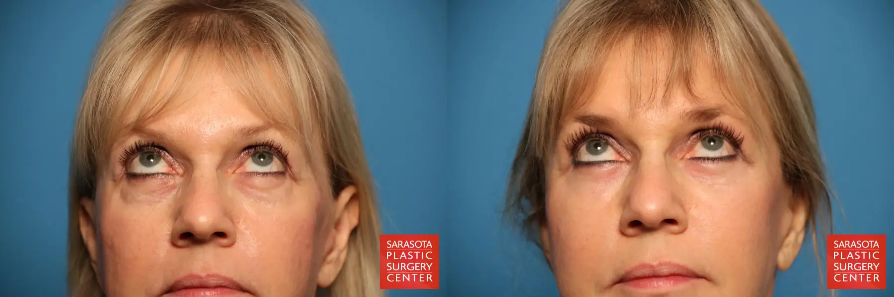 Eyelid Lift: Patient 7 - Before and After 3
