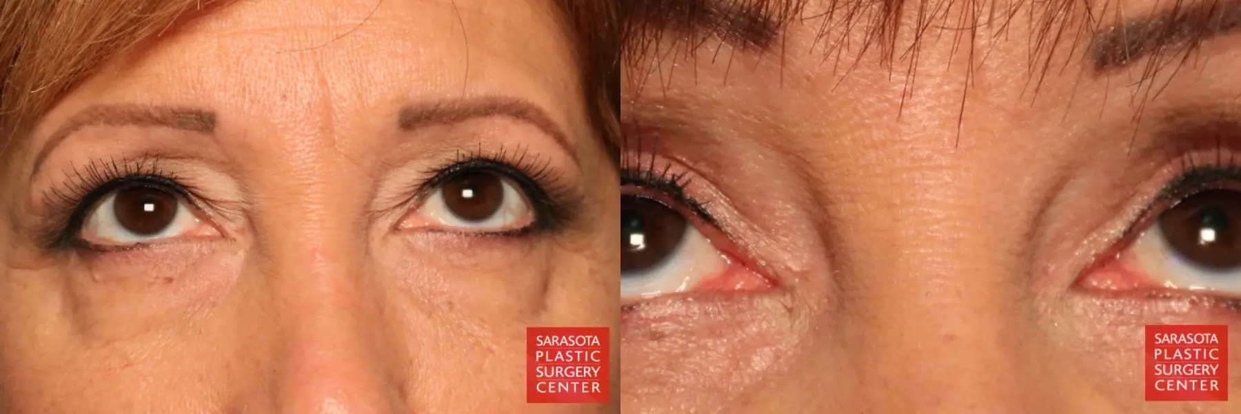 Eyelid Lift: Patient 9 - Before and After 3